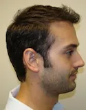 Ryan Right View - 1st Surgery