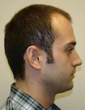 Ryan Right View - Before