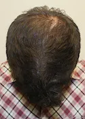 Ryan Tilt View - 2nd Procedure