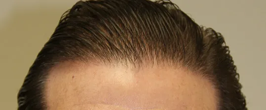 Josh Engoren final documented hair growth follow-up
