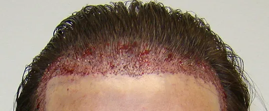Josh Engoren immediately after hair transplant surgery