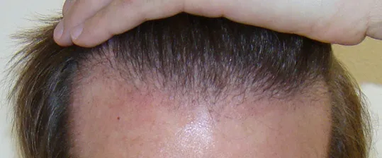 Josh Engoren healing progress after hair transplant