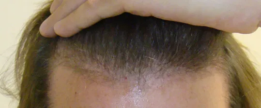 Josh Engoren early hair growth after hair transplant