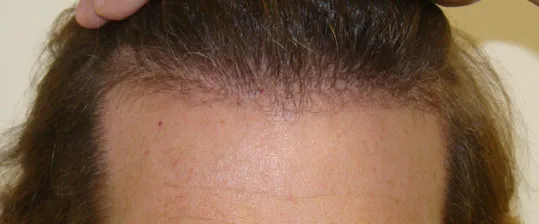Josh Engoren continued hair growth after hair transplant