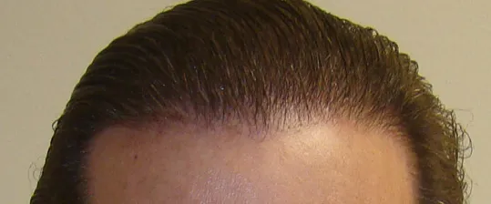 Josh Engoren hair density progress after hair transplant