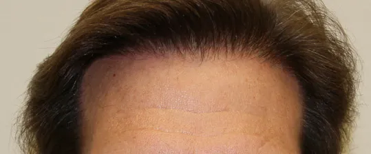 Josh Engoren maturing hair growth after hair transplant