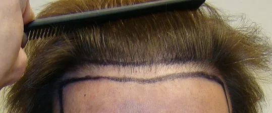 Josh Engoren treatment planning before hair transplant