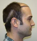 Ryan Donor Area - Shaved