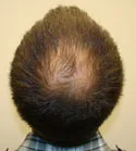 Ryan Crown View - Before