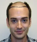 Ryan with shaved head before hair transplant