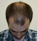 Ryan Front Tilt - Before