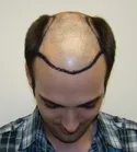 Ryan Front Tilt - Target Area