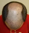 Ryan Front Tilt - 4 Days