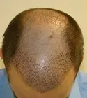 Ryan Front Tilt - 6 Days