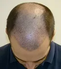Ryan Front Tilt - 9 Days