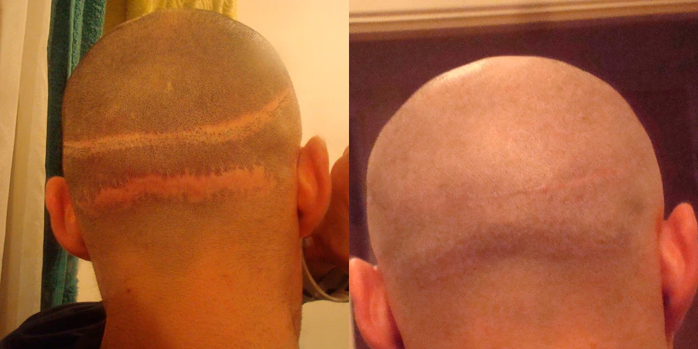 Corrective hair transplant