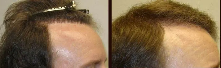 Corrective hair transplant hairline