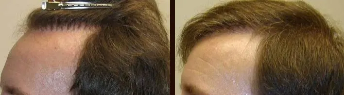 Corrective hair transplant scar repair