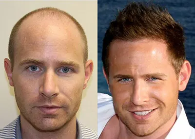 Hair transplant before and after result - Dr. Brett Bolton patient