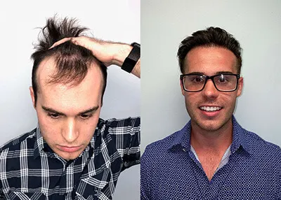 Hair transplant before and after result - Dr. Brett Bolton patient