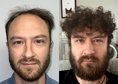 Hair transplant before and after result - Dr. Brett Bolton patient