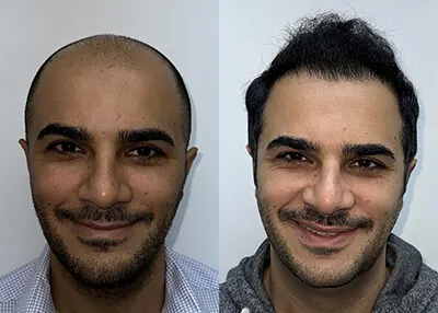Hair transplant before and after result - Dr. Brett Bolton patient