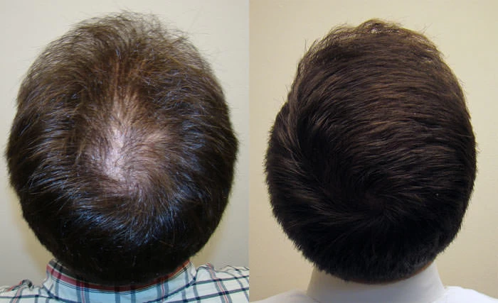 Patient p100 hair transplant before and after crown view