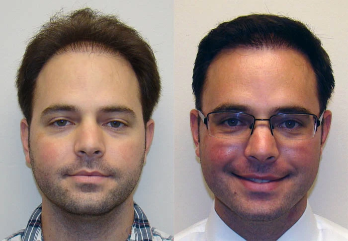 Josh Hair Transplant Before and After