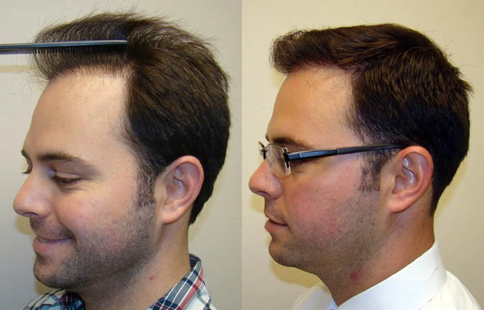 Patient p100 hair transplant before and after left view