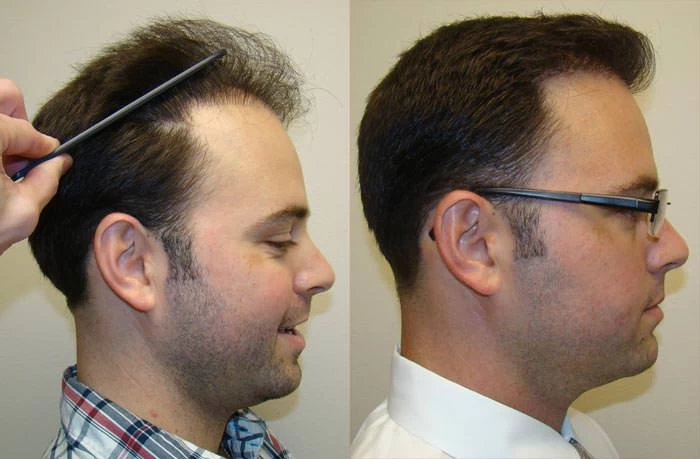 Patient p100 hair transplant before and after right view