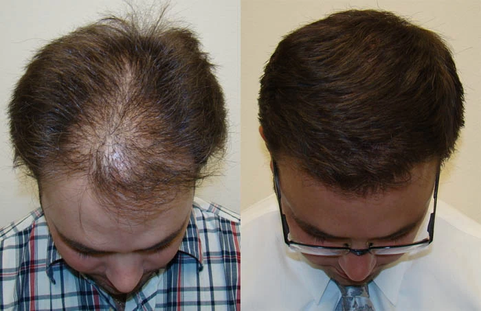 Patient p100 hair transplant before and after tilt view