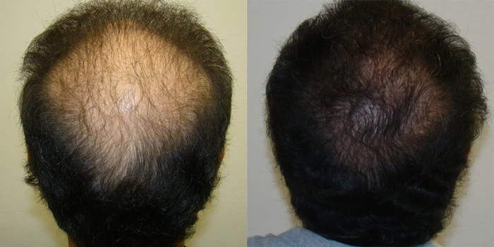 Patient p101 hair transplant before and after crown view