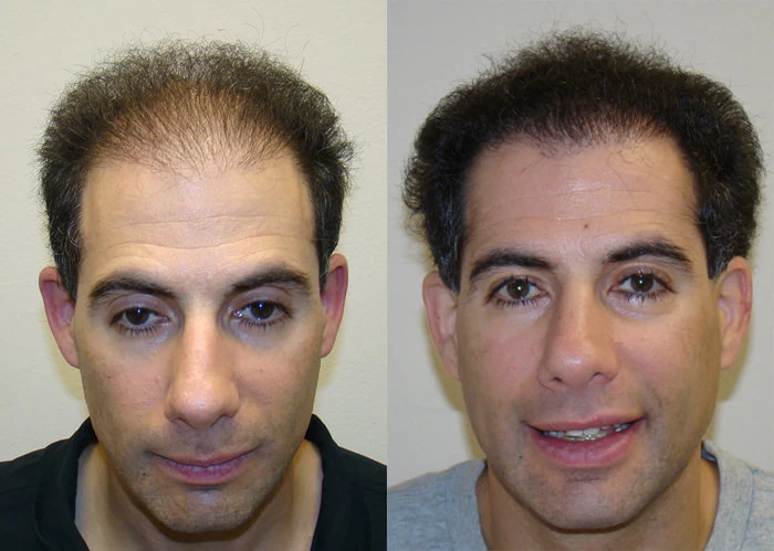 David Hair Transplant Before and After