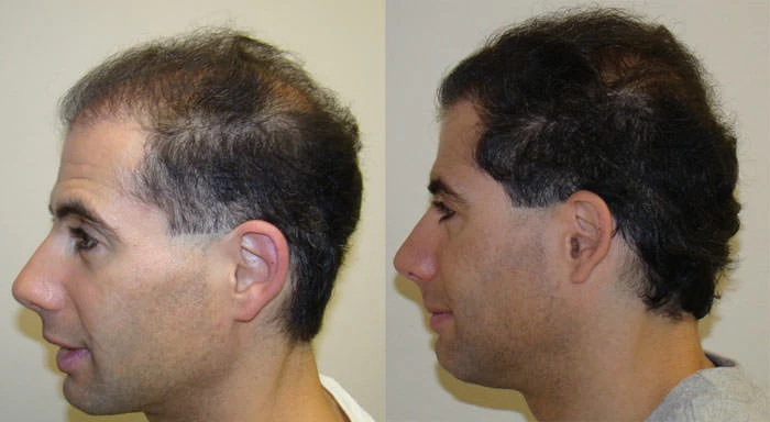 Patient p101 hair transplant before and after left view
