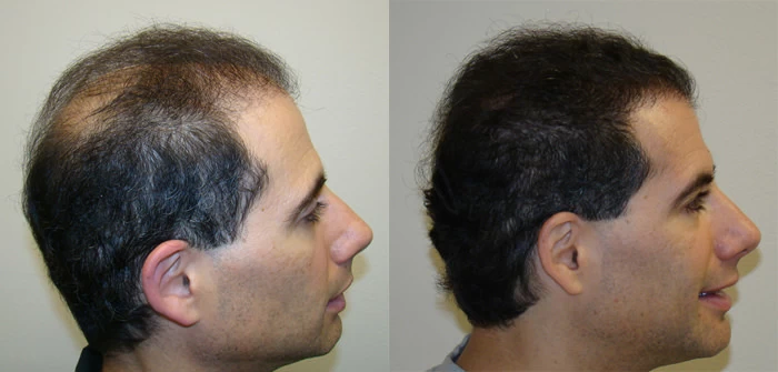 Patient p101 hair transplant before and after right view