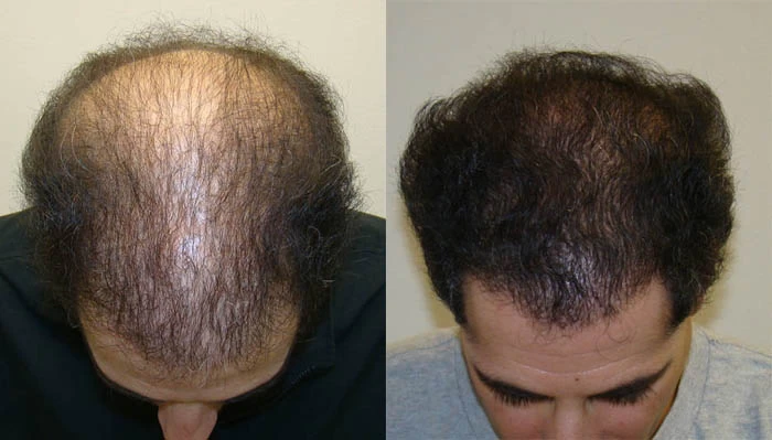 Patient p101 hair transplant before and after tilt view