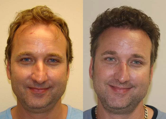 Scott Hair Transplant Before and After