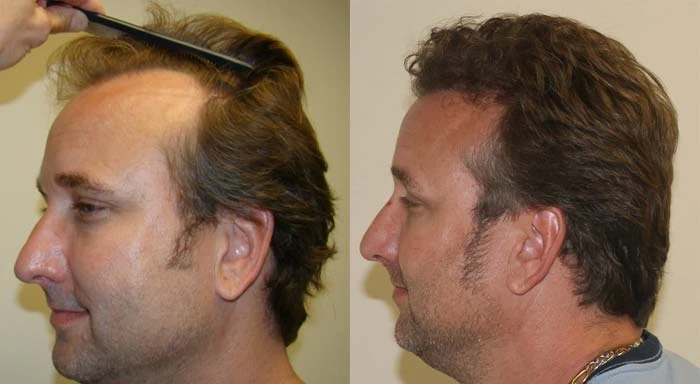 Patient p102 hair transplant before and after left view