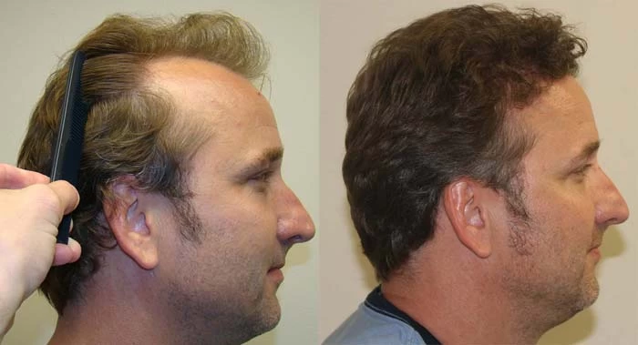 Patient p102 hair transplant before and after right view