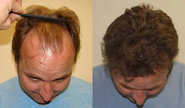 Patient p102 hair transplant before and after tilt view