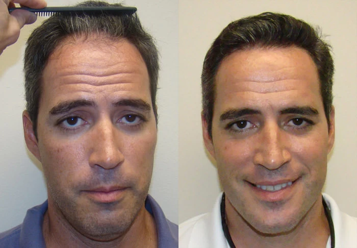 Patient 103 Hair Transplant Before and After