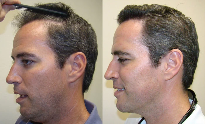 Patient p103 hair transplant before and after left view