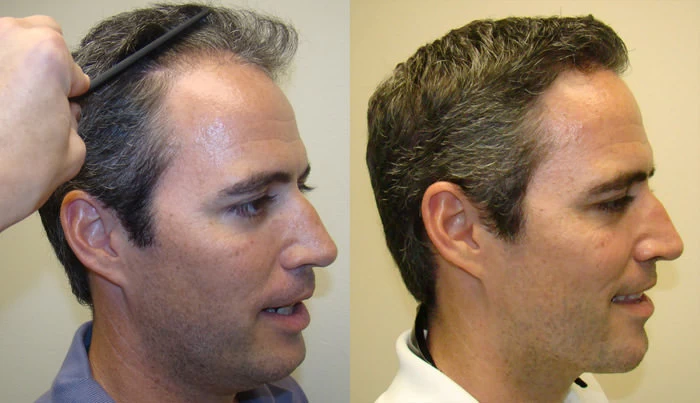 Patient p103 hair transplant before and after right view