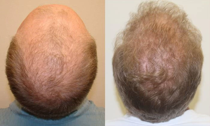 Patient p107 hair transplant before and after crown view