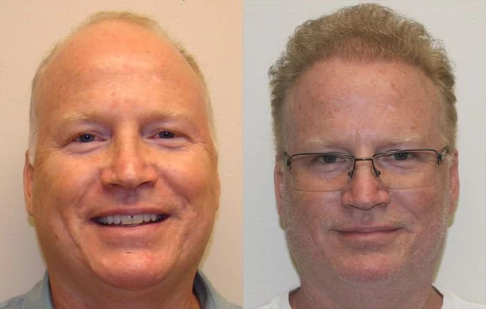 Ed Hair Transplant Before and After