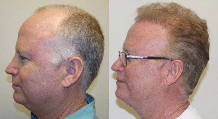 Patient p107 hair transplant before and after left view