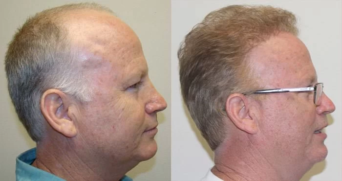 Patient p107 hair transplant before and after right view