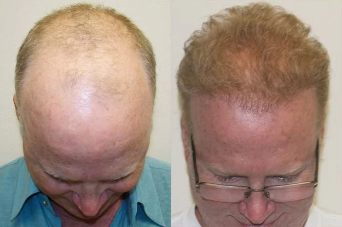 Patient p107 hair transplant before and after tilt view