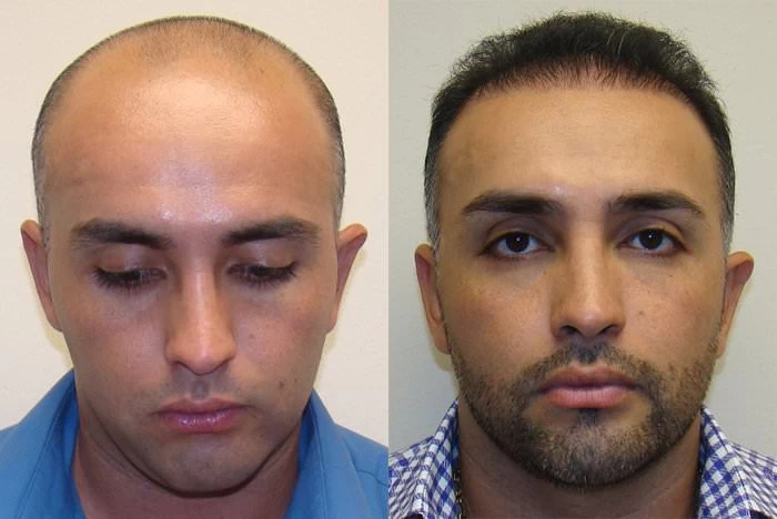 Jamie Hair Transplant Before and After