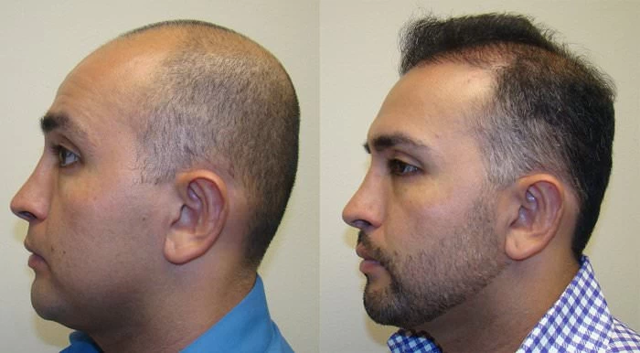Patient p109 hair transplant before and after left view